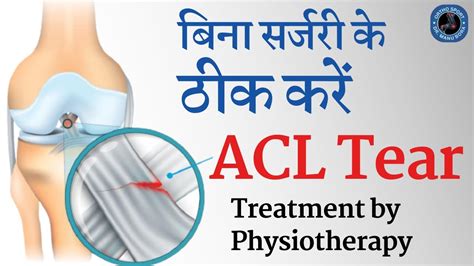 complete acl tear treatment without surgery