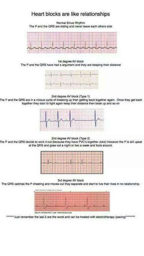 complete heart block icd 10 diagnosis