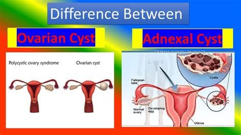 complex left adnexal cyst