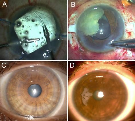 complications during cataract surgery