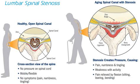 complications of spinal stenosis surgery