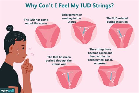 complications with iud removal