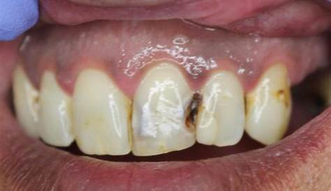 Composite Filling Anterior () New Horizons Family Dental