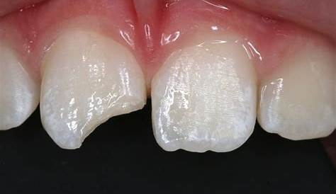 Before and After Patient had old composite fillings on
