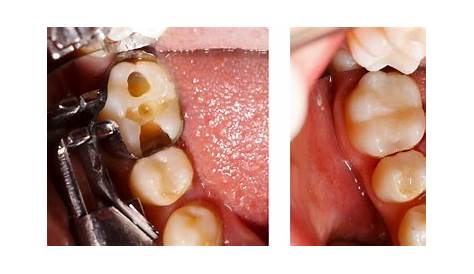 Stronger material for filling dental cavities has