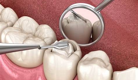 Invisible Fillings Why Composite Fillings are Awesome
