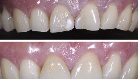 Composite Filling On Front Tooth Colored s Gallery Dr. Jack M. Hosner, D.D.S.
