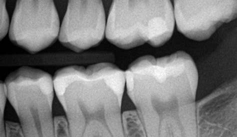 Composite Filling Radiograph Artistry The Tooth, The Whole Tooth And