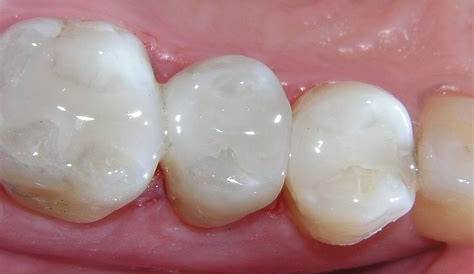 Composite Filling Teeth WhiteHot s Vibrant Smiles Mableton GA