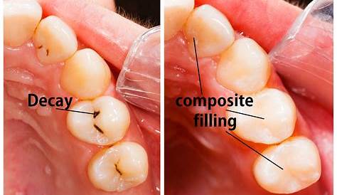 Composite Filling Invisible s Why s Are Awesome