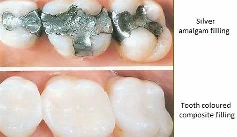 Composite Fillings Vs Amalgam Dental Associates Of West Michigan Differences Between