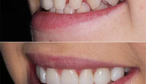 Composite Veneers Before and After Mooresville, NC