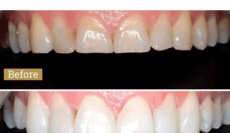 Dental Veneers Cost Near Me Local Dentist Search