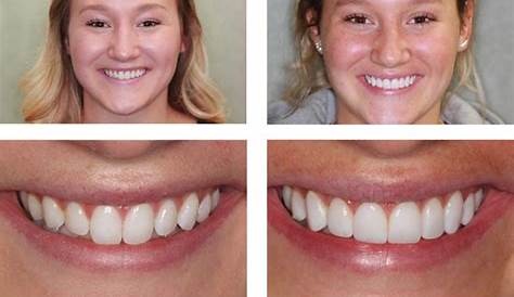 Composite Veneers Cost Nz Porcelain Answering The Most Important Questions