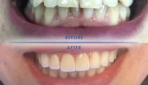 Composite Veneers Cost Turkey Dental In Teeth Veneer In