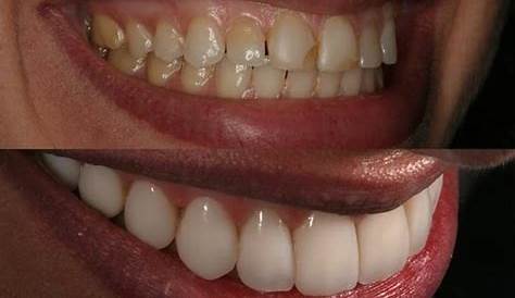 Composite Veneers We compare safety, durability