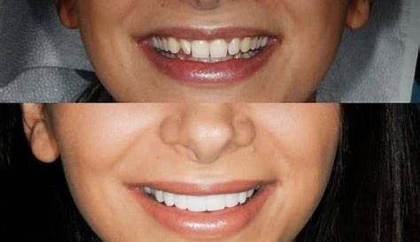 Composite Veneers Cost In Colombia. Maximum Quality At An