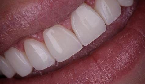 Essential guide to Composite Veneers Shine Dental