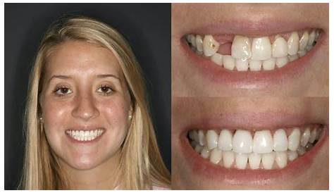 Before & After Composite Veneers/Whitening 2