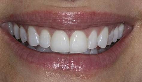 Porcelain VS Composite Veneers Everything You Need to