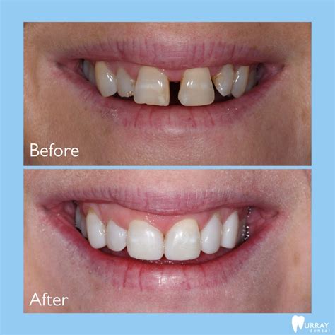 Composite Bonding Tooth Gap