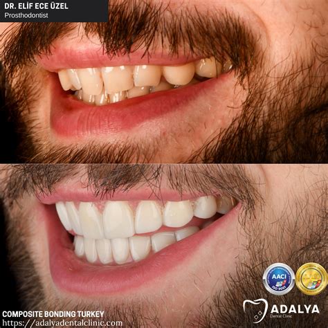 Composite Bonding Veneers Turkey