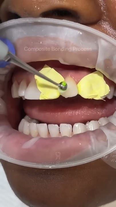 Composite Bonding Youtube