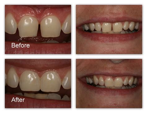 Composite Filling Front Tooth Cost Uk
