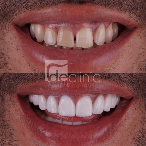 Composite Laminate Teeth