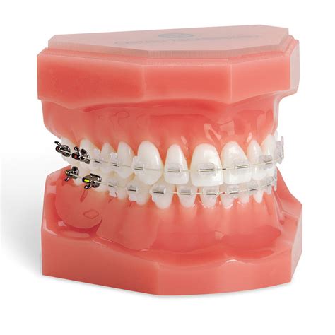 Composite Orthodontic Archwire