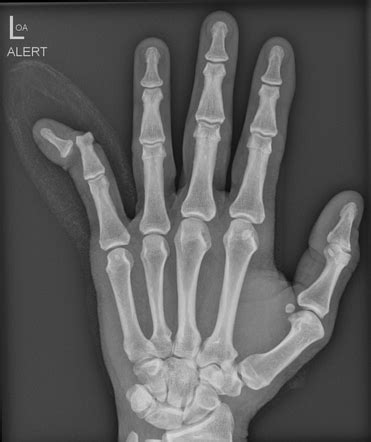 Compound Fracture Xray