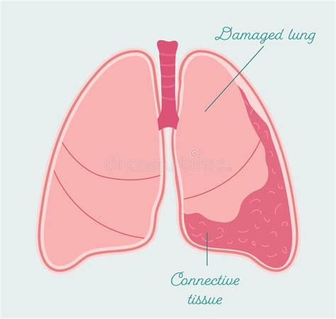 Compressed Lung Symptoms