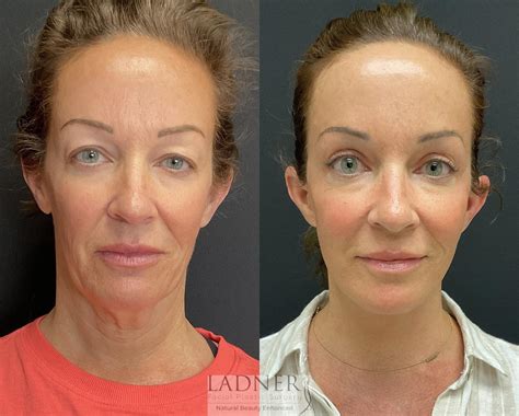 Compression After Facelift