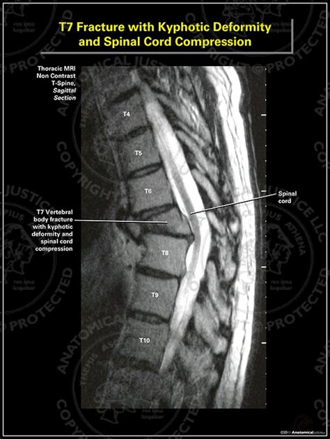 Compression Fracture At T7
