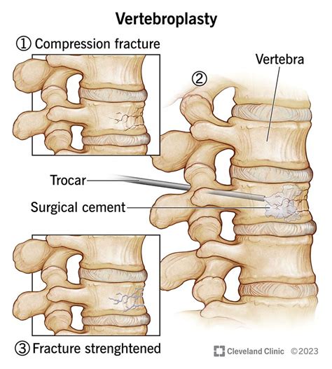 Compression Fracture Cement