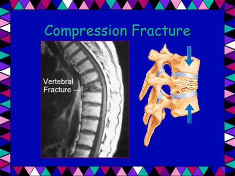 Compression Fracture Cks