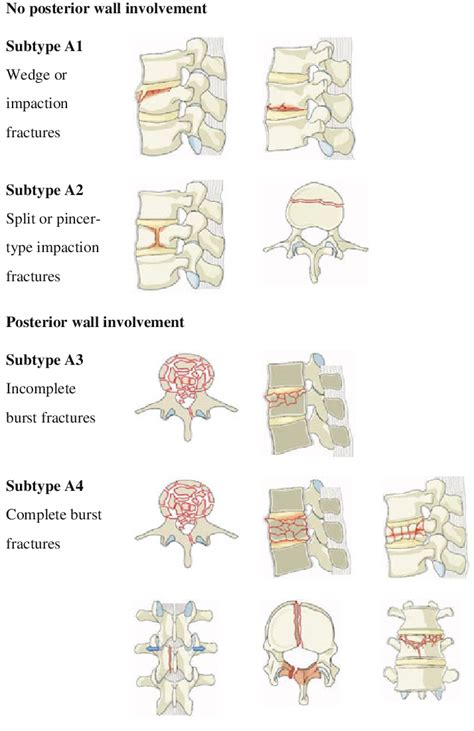 Compression Fracture Classification