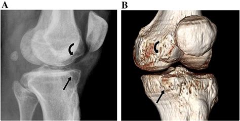 Compression Fracture Knee