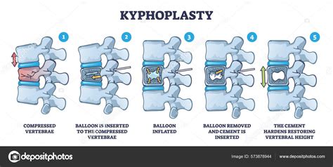 Compression Fracture Kyphoplasty Indications