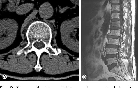 Compression Fracture Multiple Myeloma