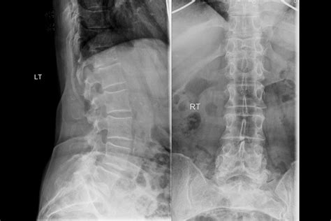 Compression Fracture Nice Cks