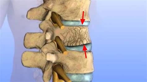 Understanding Compression Fracture of the Spine Causes and Treatment