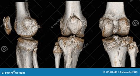 Compression Fracture Of Tibia