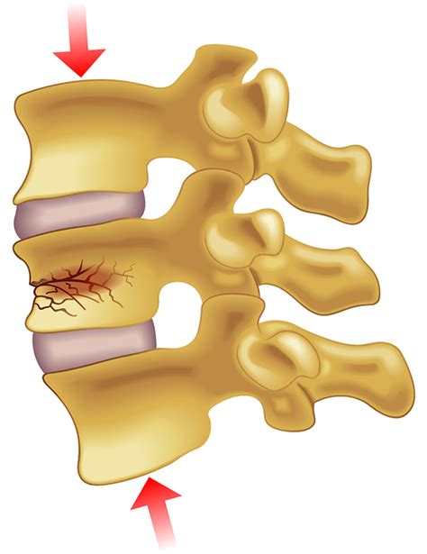 compression fracture of vertebrae