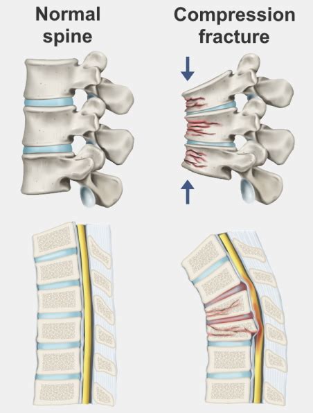 Compression Fracture Pathophysiology