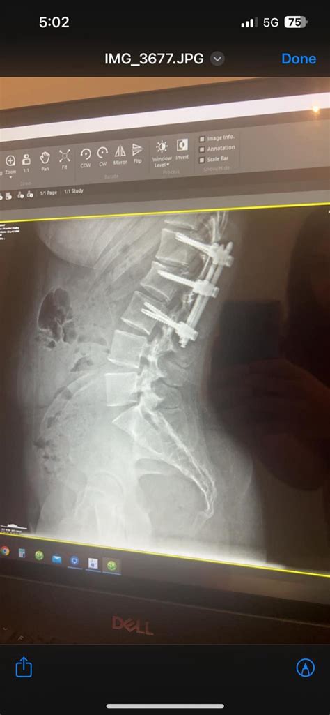 Compression Fracture Reddit