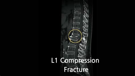 Compression Fracture Spine Icd 10