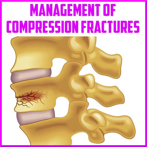 Understanding Compression Fracture Treatment: Options for Relief and Recovery