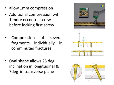 Compression Plate Lock-Up