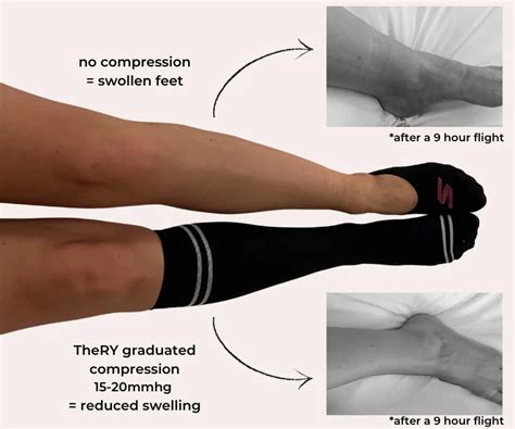 Compression Socks In Labour